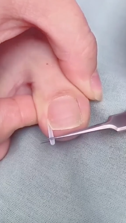 Ingrown Toenail Strips